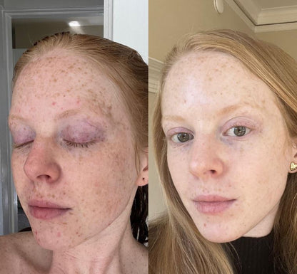 Almohadillas Limpiadoras con Ácido Kójico y Cúrcuma – Exfoliación Suave y Luminosidad Natural