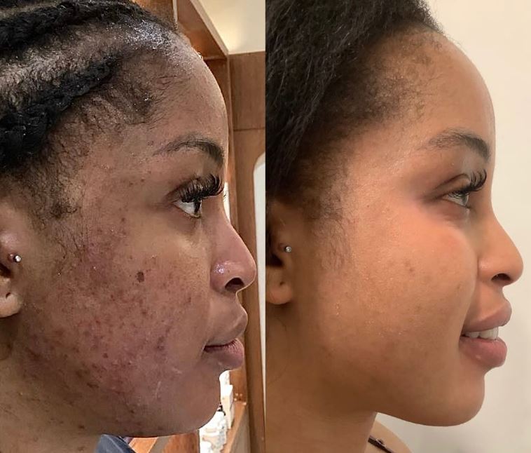 Almohadillas Limpiadoras con Ácido Kójico y Cúrcuma – Exfoliación Suave y Luminosidad Natural